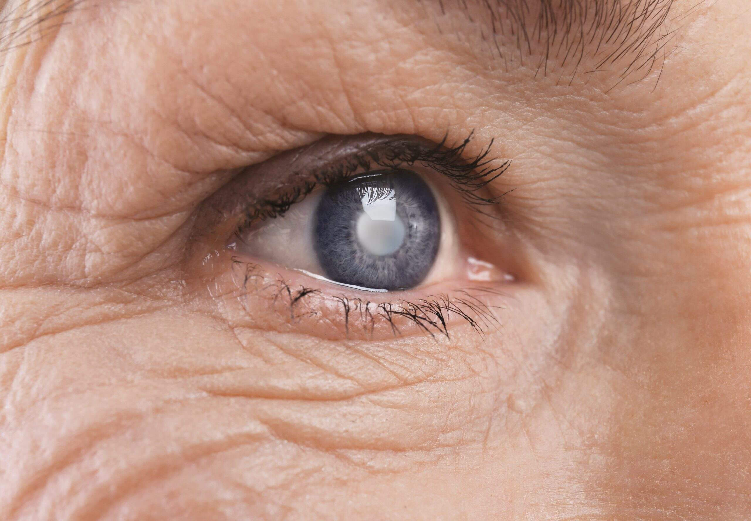 glaucoma-quiz