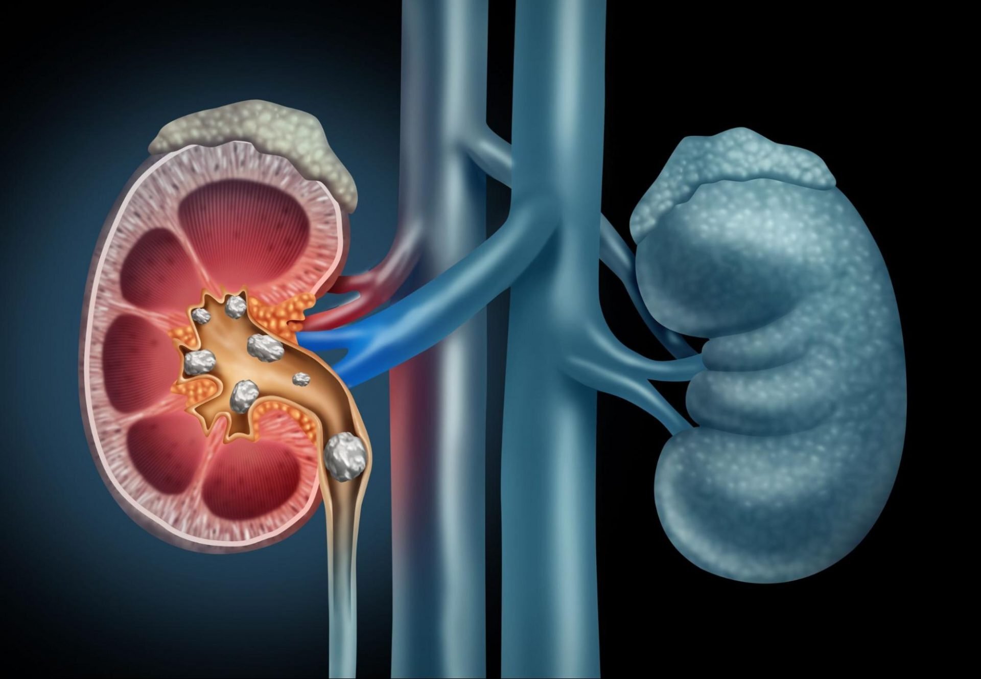 kidney-stone-or-uti-quiz